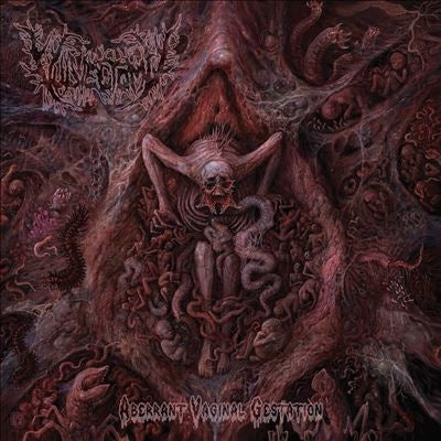 Vulvectomy - Aberrant Vaginal Gestation - Import CD